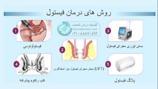  عکس عفونت مقعدی
