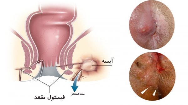  عکس عفونت مقعدی
