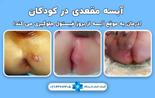  بیماری فیستول مقعدی در زنان