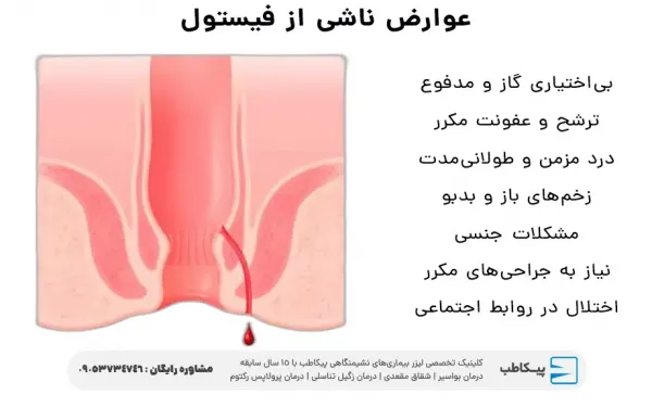  بیماری فیستول مقعدی در زنان