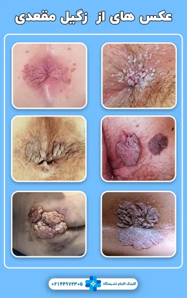 آیا زگیل مقعدی خارش دارد؟