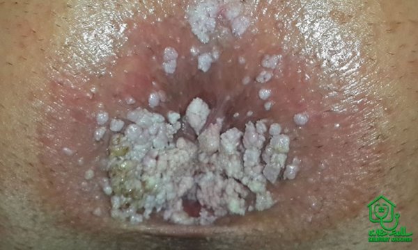  آیا زگیل مقعدی خارش دارد؟