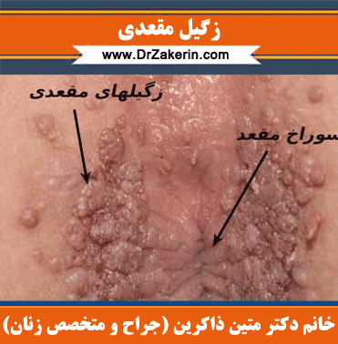  آیا زگیل مقعدی خارش دارد؟