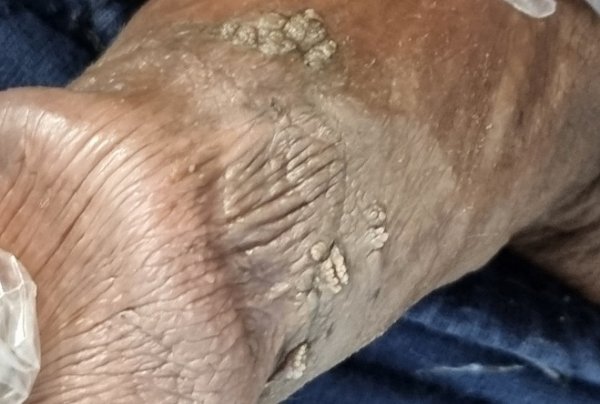  عکس زگیل مقعدی خفیف