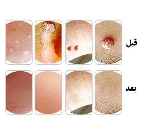  عکس زگیل مقعدی خفیف