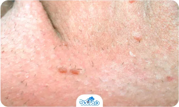 عکس زگیل مقعدی خفیف