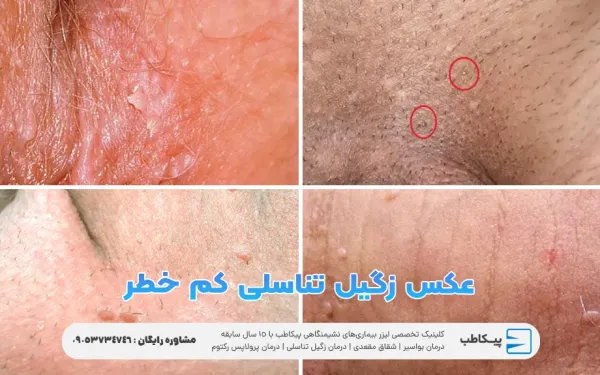  عکس زگیل مقعدی خفیف