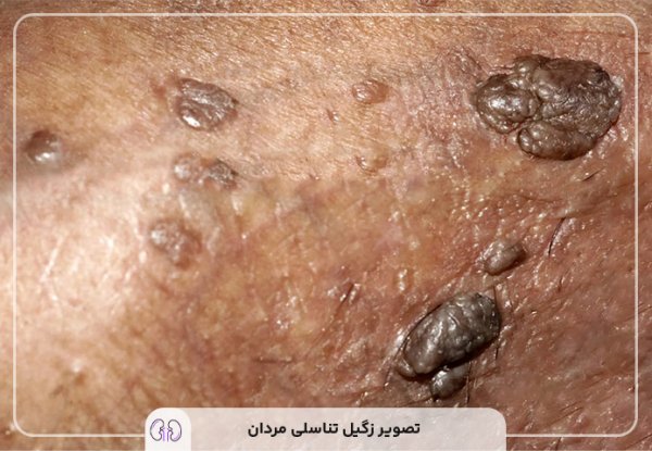  عکس زگیل مقعدی خفیف