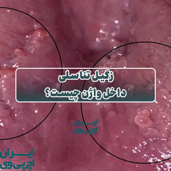 عکس زگیل تناسلی در داخل واژن