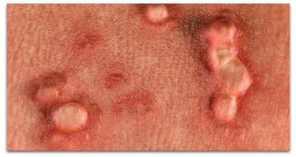  عکس زگیل تناسلی در داخل واژن