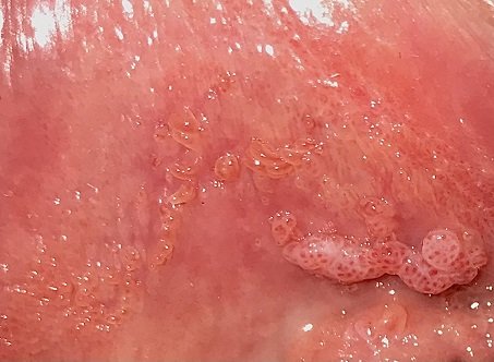  عکس زگیل تناسلی در داخل واژن