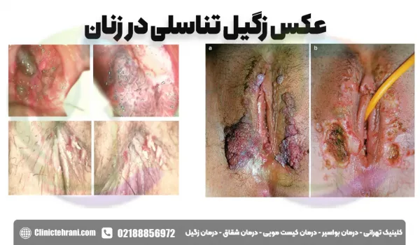  عکس زگیل تناسلی در داخل واژن