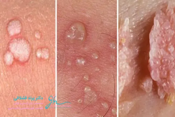  زگیل مقعدی در کودکان