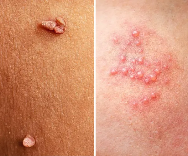  زگیل مقعدی در کودکان