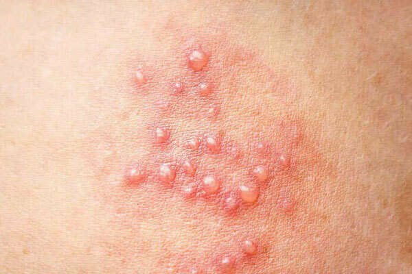  زگیل مقعدی در کودکان