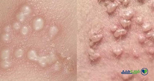  زگیل مقعدی در کودکان