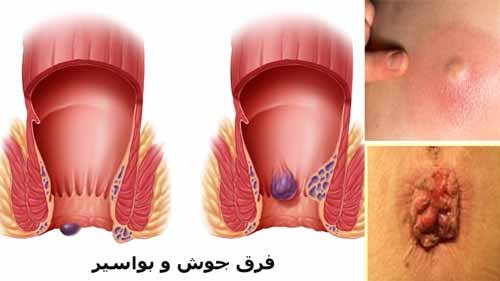 فرق جوش مقعدی با بواسیر