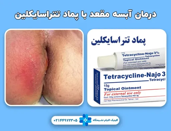  فرق جوش مقعدی با بواسیر