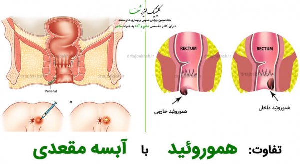  فرق جوش مقعدی با بواسیر