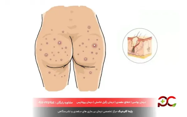  فرق جوش مقعدی با بواسیر