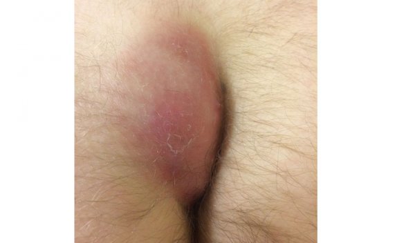  فرق جوش مقعدی با بواسیر