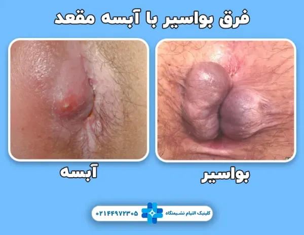  فرق جوش مقعدی با بواسیر