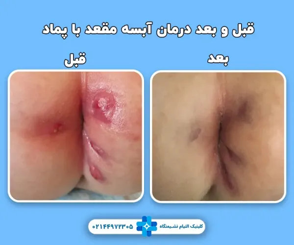  بهترین پماد برای جوش مقعدی