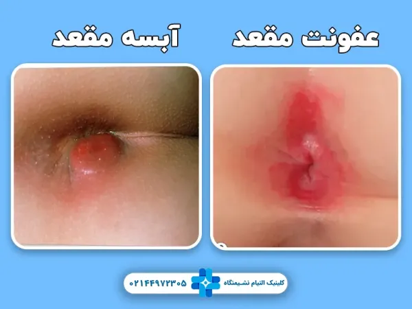  درمان عفونت مقعدی خانگی