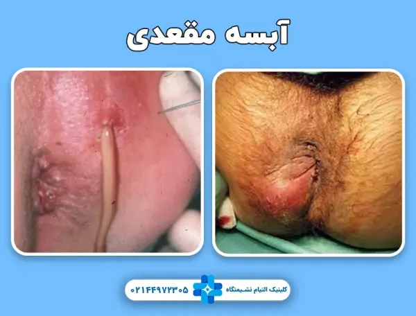  درمان عفونت مقعدی خانگی