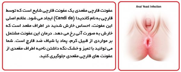  درمان عفونت مقعدی خانگی