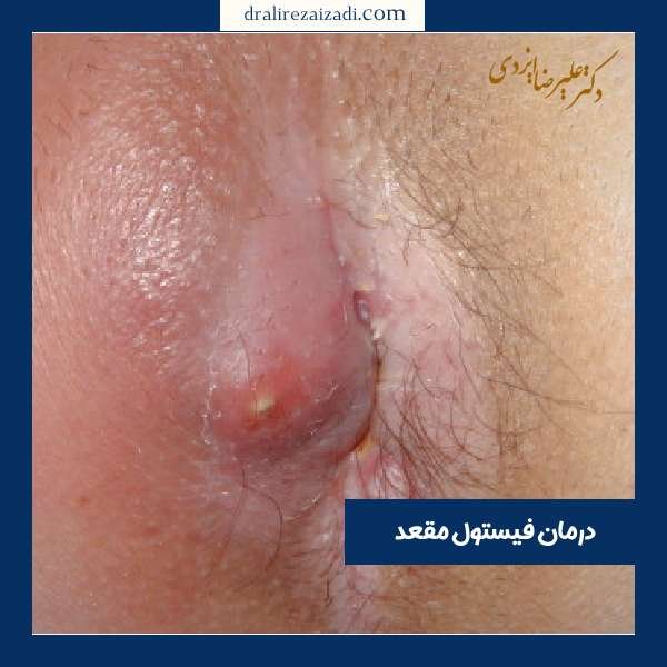  برای درمان جوش مقعدی به چه دکتری مراجعه کنیم؟