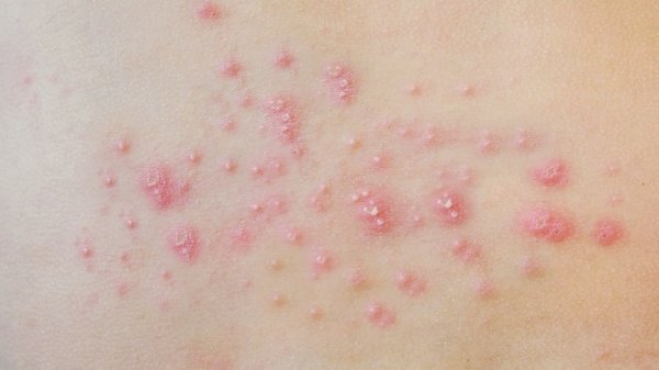  برای درمان جوش مقعدی به چه دکتری مراجعه کنیم؟