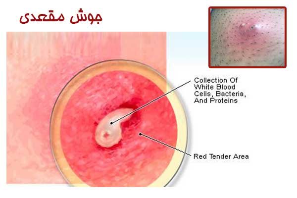  جوش داخل مقعدی نشانه چیست؟