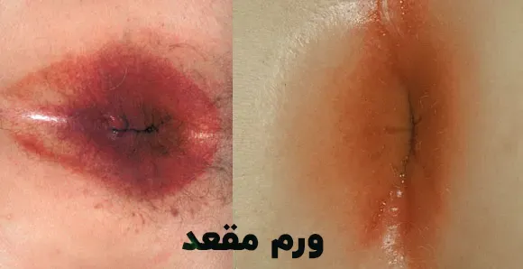 عکس ورم مقعدی