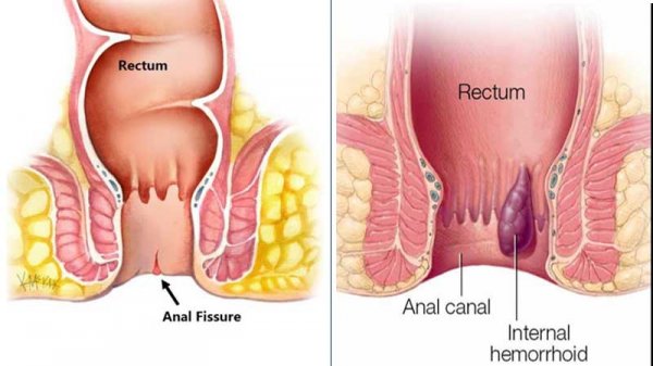  عکس ورم مقعدی