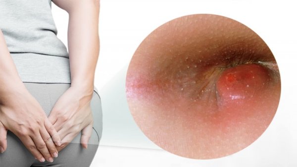 درمان ورم مقعدی در طب سنتی+بهترین پماد برای ورم مقعدی