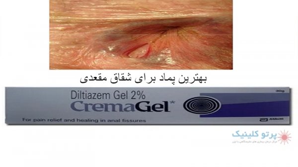  درمان ورم مقعدی در طب سنتی+بهترین پماد برای ورم مقعدی