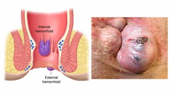  درمان ورم مقعدی در طب سنتی+بهترین پماد برای ورم مقعدی