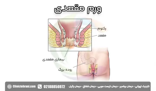  درمان ورم مقعدی در طب سنتی+بهترین پماد برای ورم مقعدی