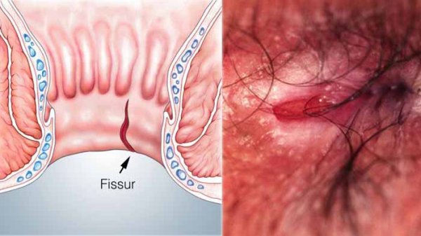  درمان ورم مقعدی در طب سنتی+بهترین پماد برای ورم مقعدی