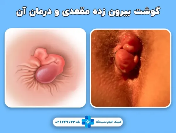 علت گوشت اضافه مقعدی زنان و مردان