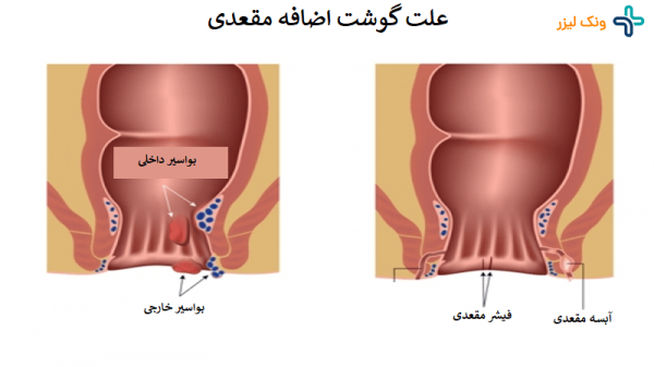  علت گوشت اضافه مقعدی زنان و مردان