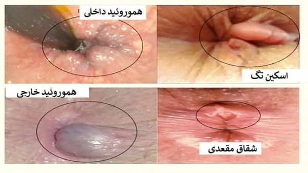  علت گوشت اضافه مقعدی زنان و مردان