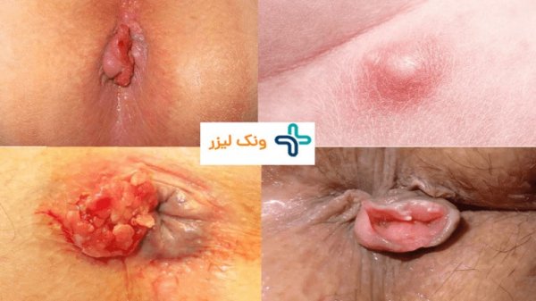  برای گوشت اضافه مقعدی به چه دکتری مراجعه کنیم؟