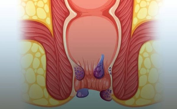  هزینه لیزر گوشت اضافه مقعدی