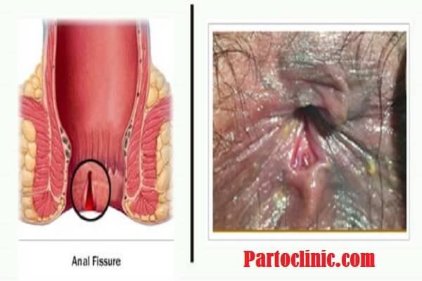 هزینه لیزر گوشت اضافه مقعدی