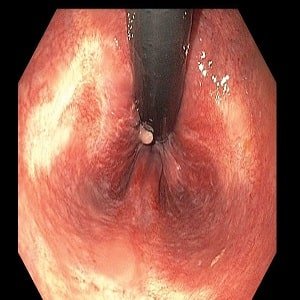  هزینه لیزر گوشت اضافه مقعدی