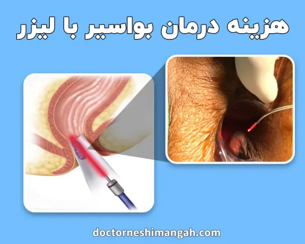  هزینه لیزر گوشت اضافه مقعدی