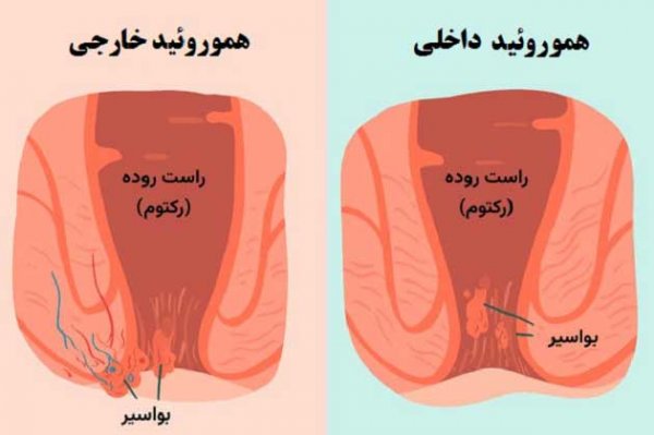  گوشت اضافه مقعدی بعد از زایمان