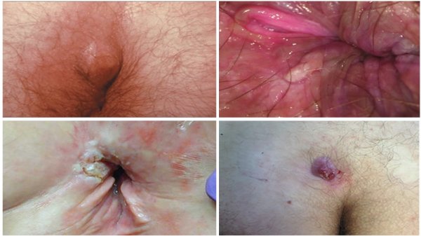 فیلم و عکس جراحی گوشت اضافه مقعدی